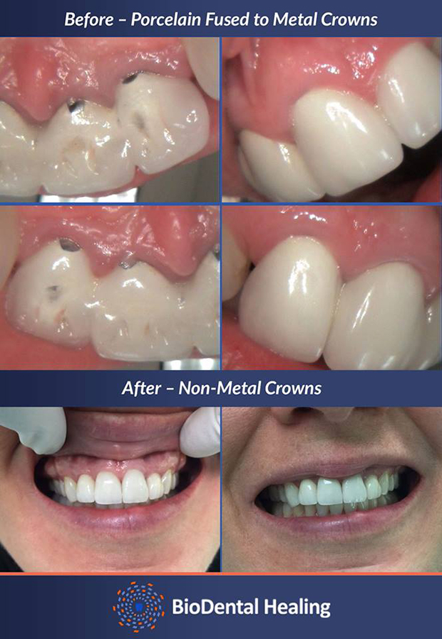 Crown Replacement